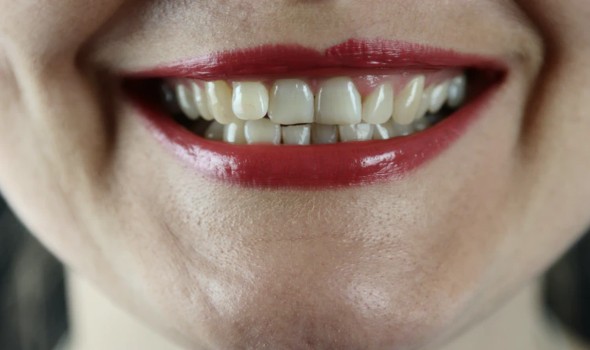ثلاثة ألوان تتراكم على الأسنان تشير إلى عدوى خطيرة مدمرة